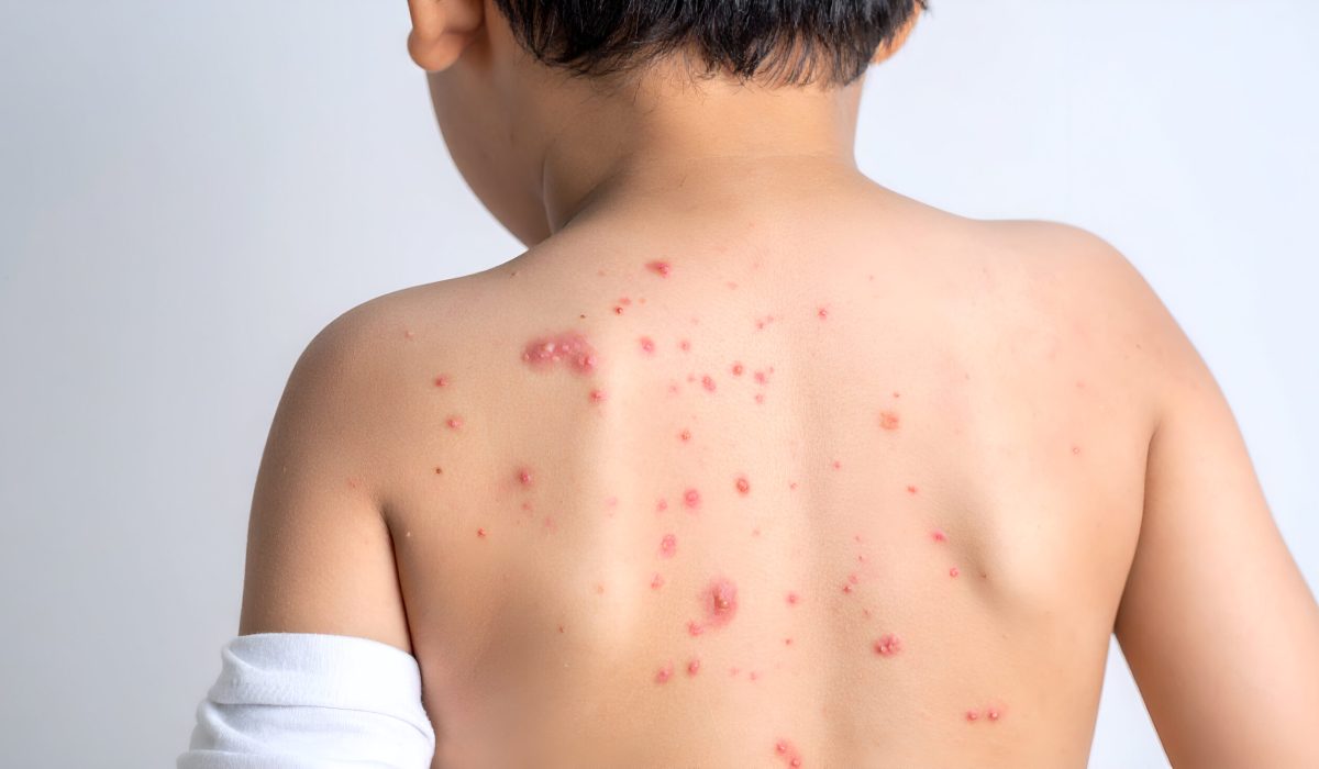Close-up view of a young child's back showing numerous chickenpox lesions.